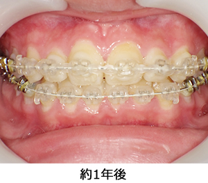 知立市 矯正歯科