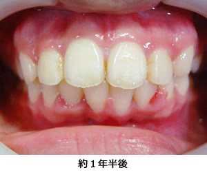 知立市 矯正歯科